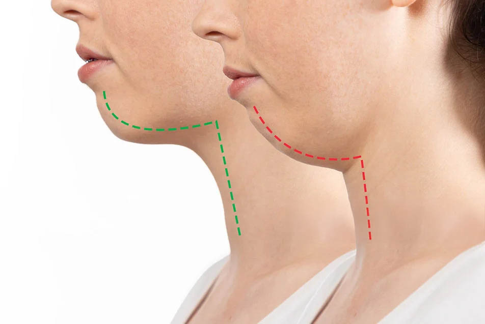 double chin fat removal