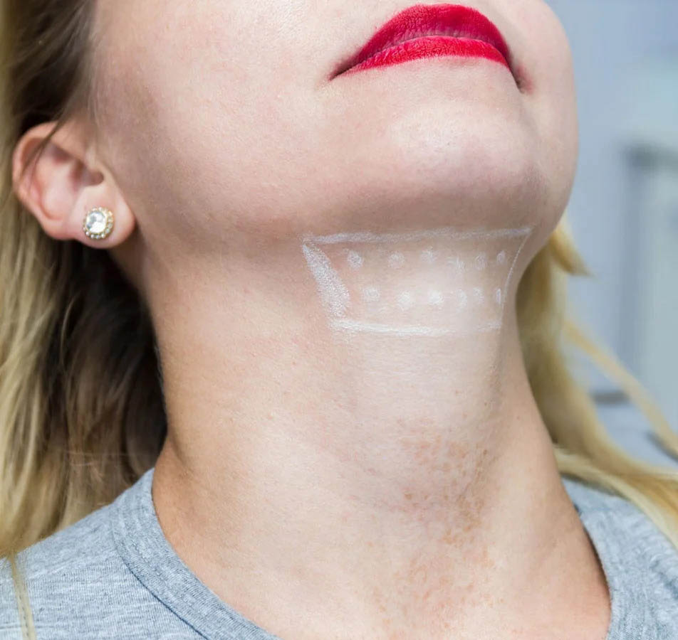 double chin lipo procedure