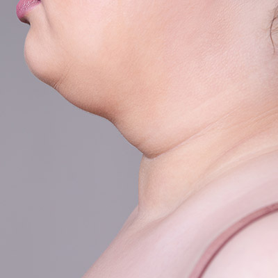 Neck Skin Tightening Excess Fat Deposits NYC