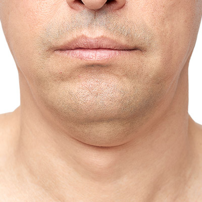 Neck Skin Tightening Loss of Definition NYC