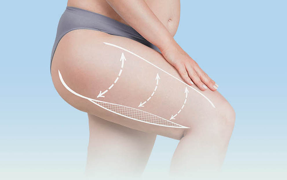 Leg Liposuction NYC