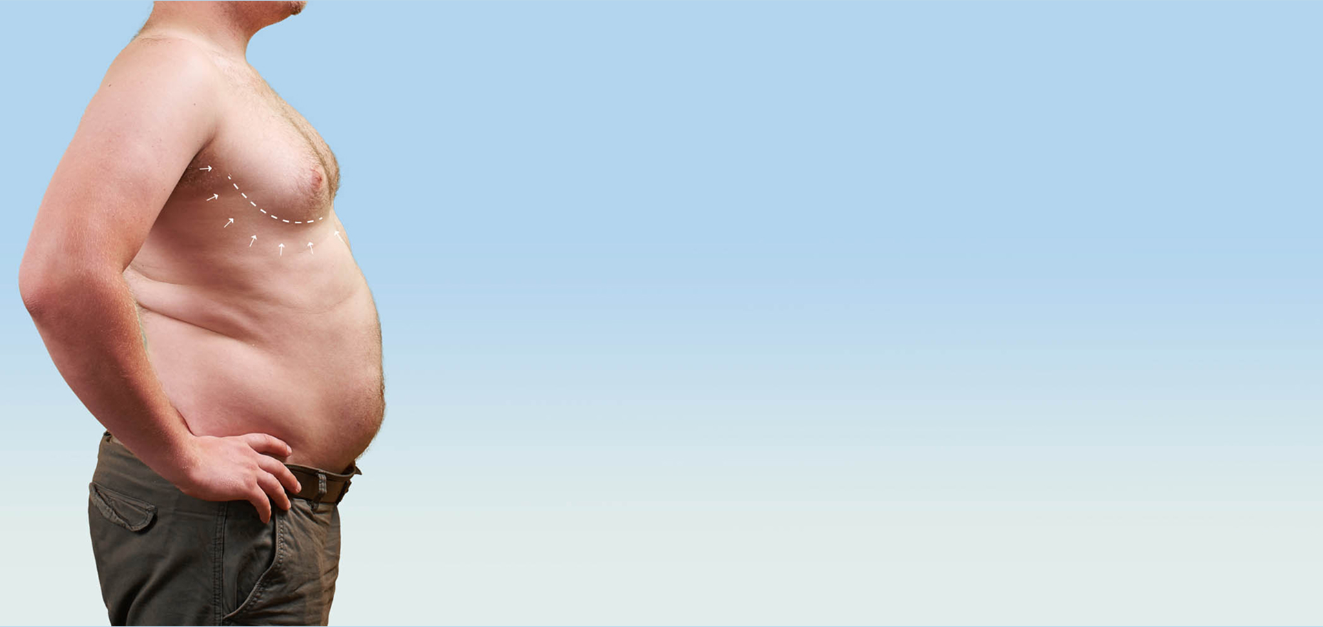 Male Breast Reduction Gynecomastia Surgery NYC