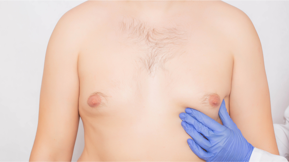 PAL gynecomastia removal surgery