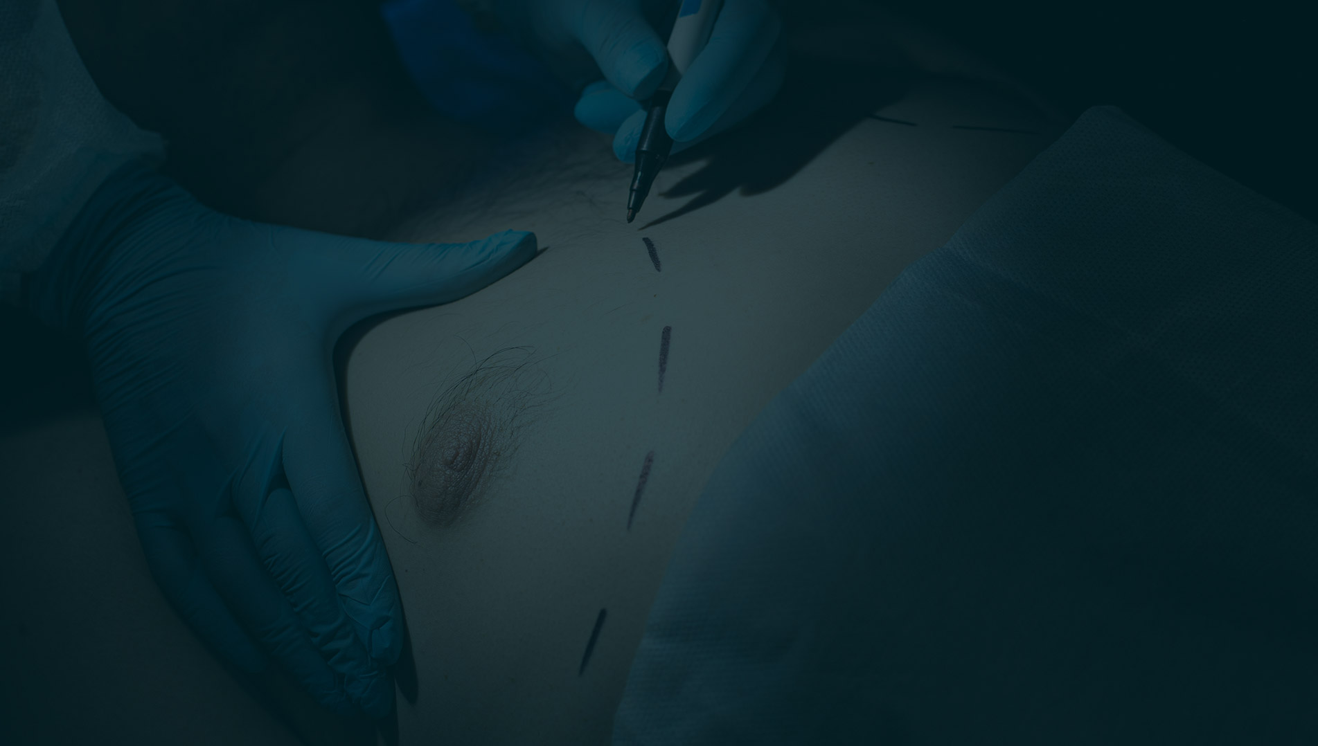 Schedule Your Free Gynecomastia Treatment in NYC