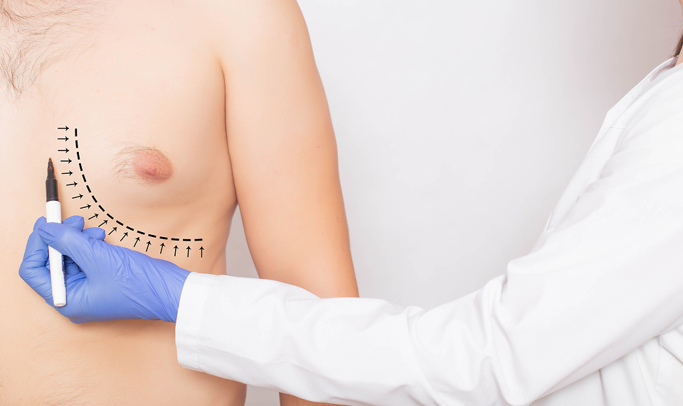 surgery for male breast reduction