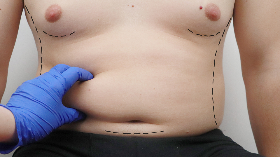 tumescent liposuction gynecomastia removal surgery