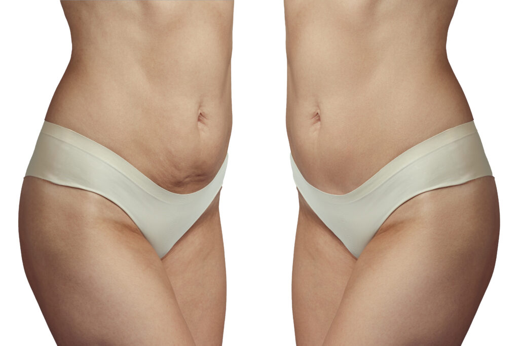abdominoplasty before and after. Correction of sagging skin. Isolated on white background.