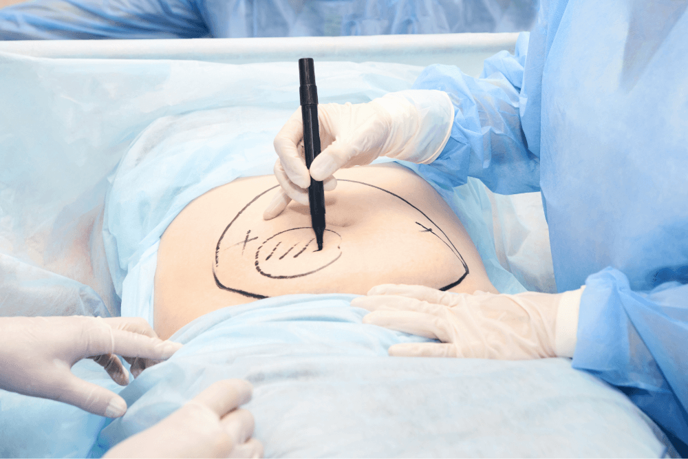 What is Power assisted liposuction NYC