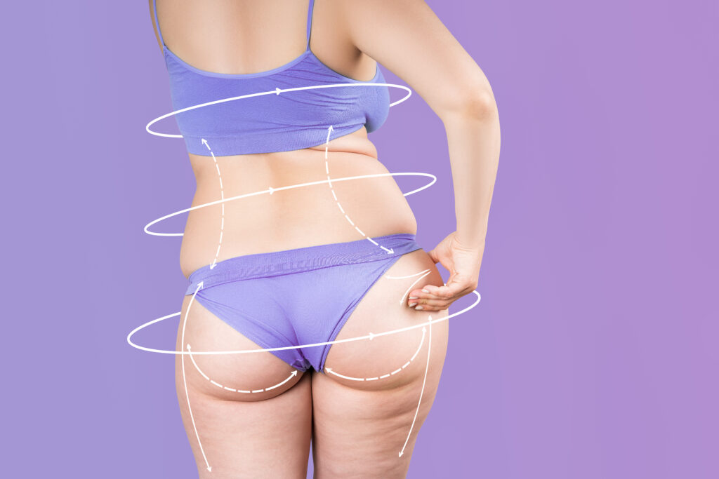 Buttocks, hip, back liposuction, fat and cellulite removal concept, overweight female body with painted surgical lines and arrows