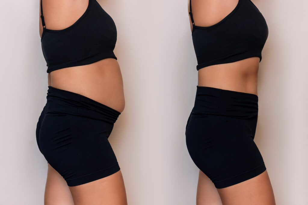 Collage of a woman in a black sportswear with a fat belly and toned slim abdomen before and after losing weight on gray background. Result of diet, training. Getting rid of overweight. Comparison