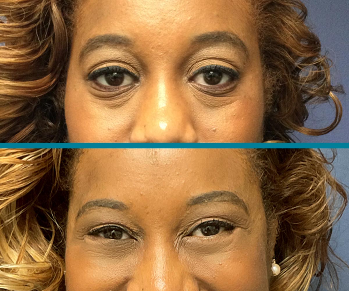Blepharoplasty 1