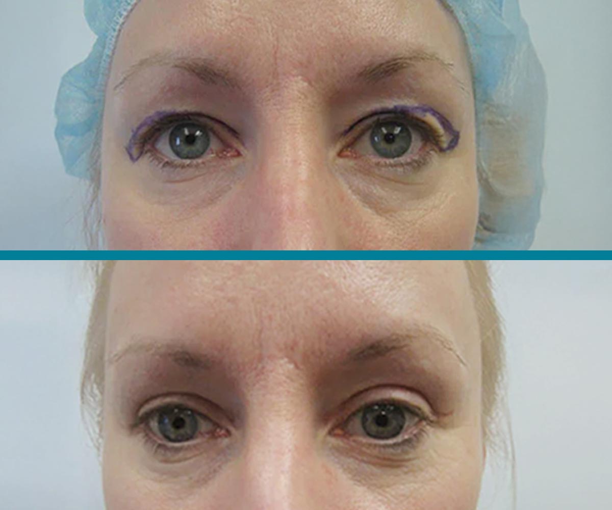 Blepharoplasty 2