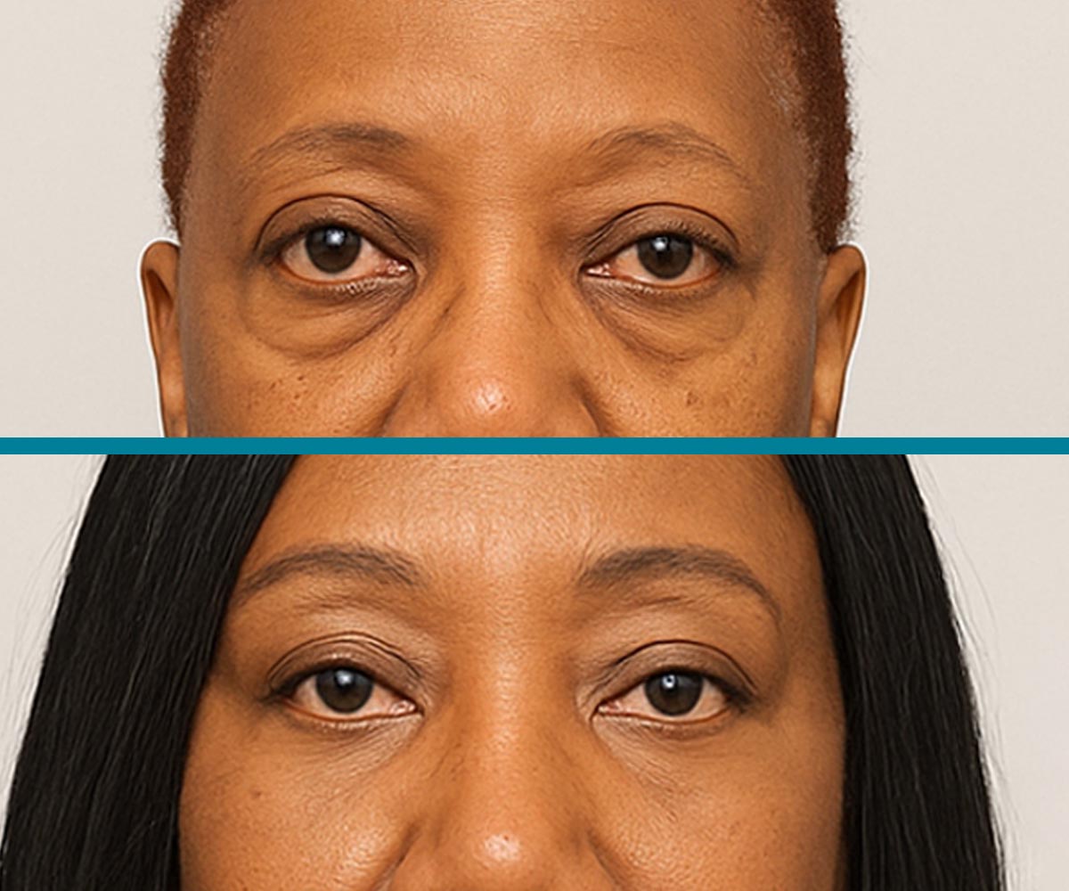 Blepharoplasty 3