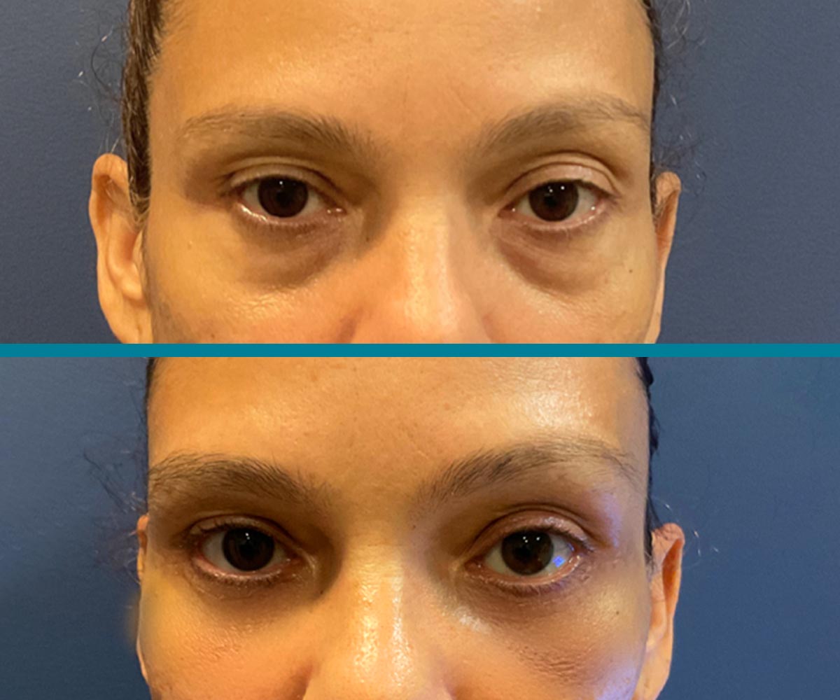 Blepharoplasty 4