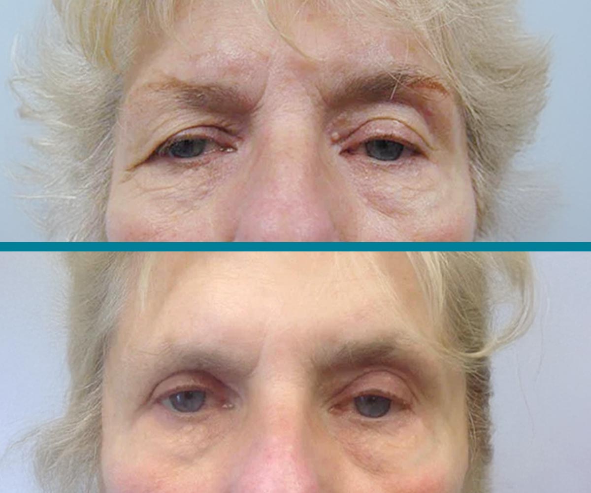 Blepharoplasty 5
