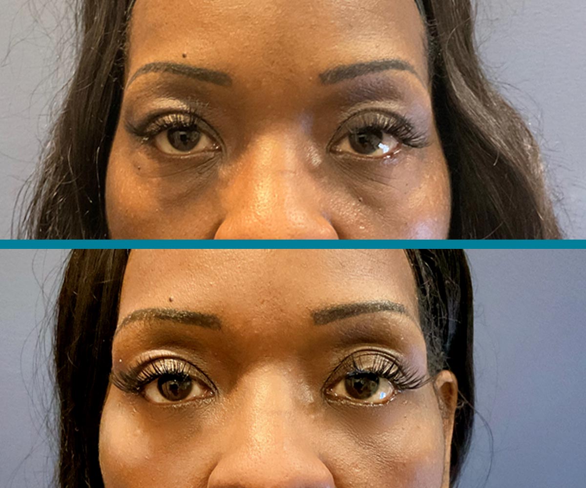 Blepharoplasty 6