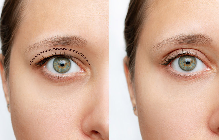 Double Eyelid Surgery (Asian Blepharoplasty)