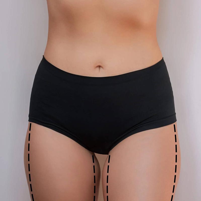 Outer Thighs (Saddlebags)