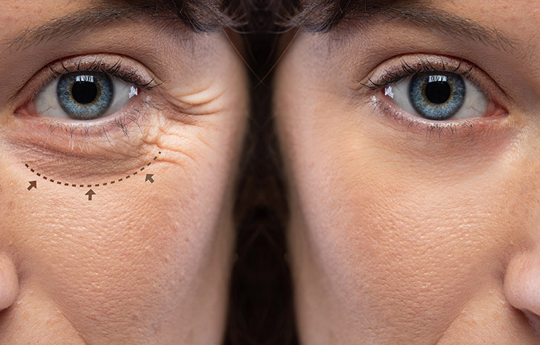 Transconjunctival Blepharoplasty