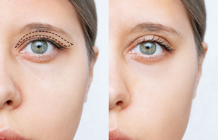 Upper Blepharoplasty