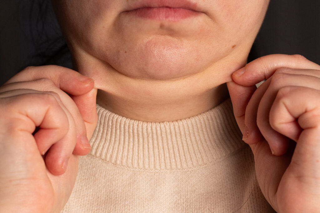 Close up image of female second chin. Overweight woman demonstrating second chin. Weight excess problem. Double chin correction surgery concept.