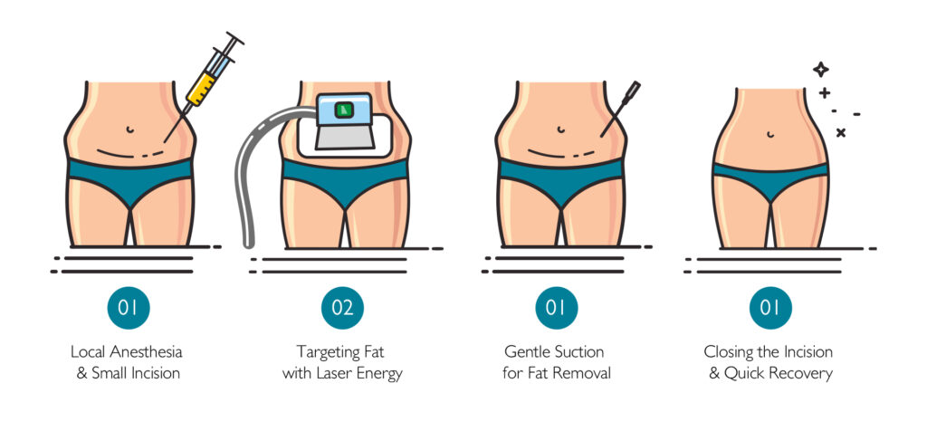 How Does Laser Lipo Work v1.0
