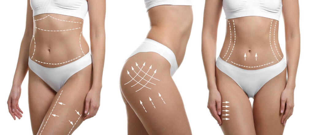 Collage of young woman in underwear on white background. Concept of plastic surgery