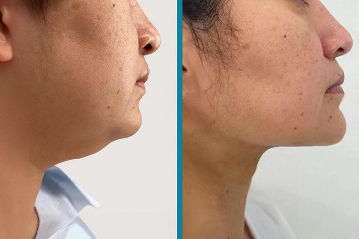 double chin liposuction 1