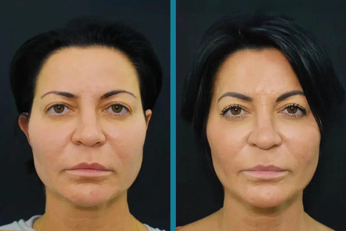 double chin liposuction 10