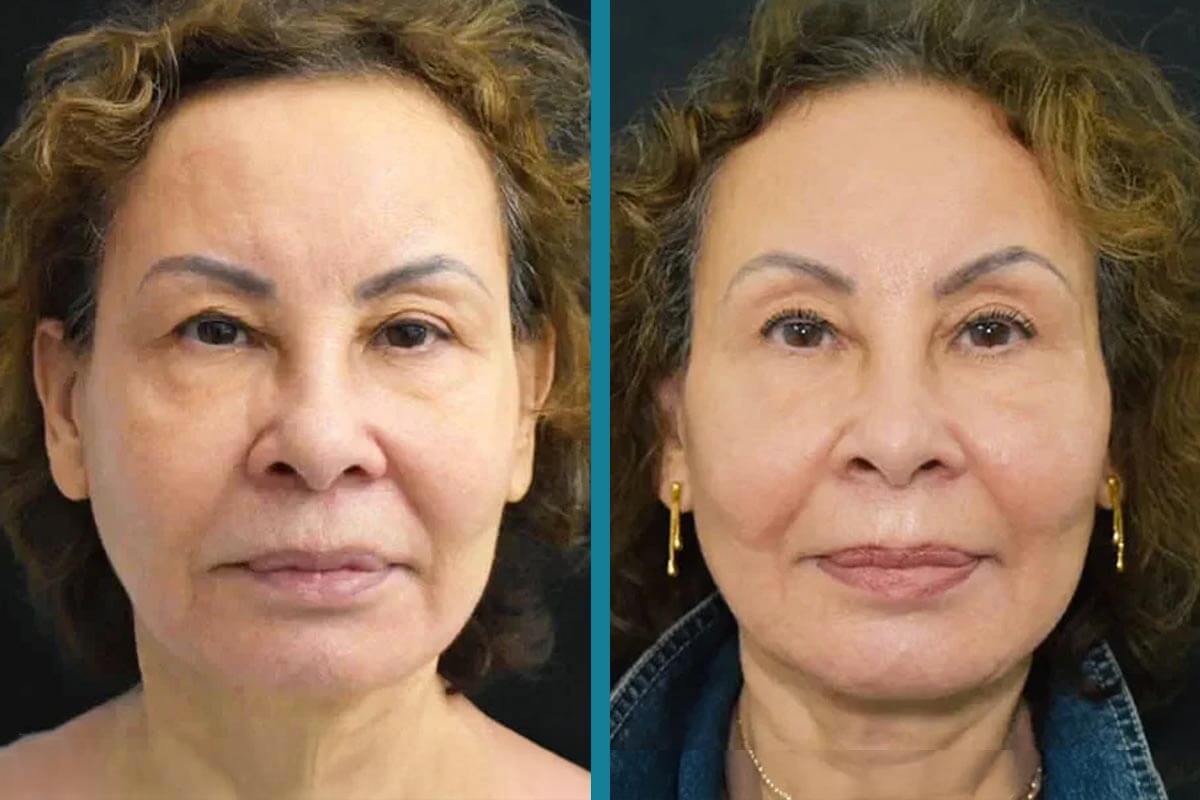 double chin liposuction 11