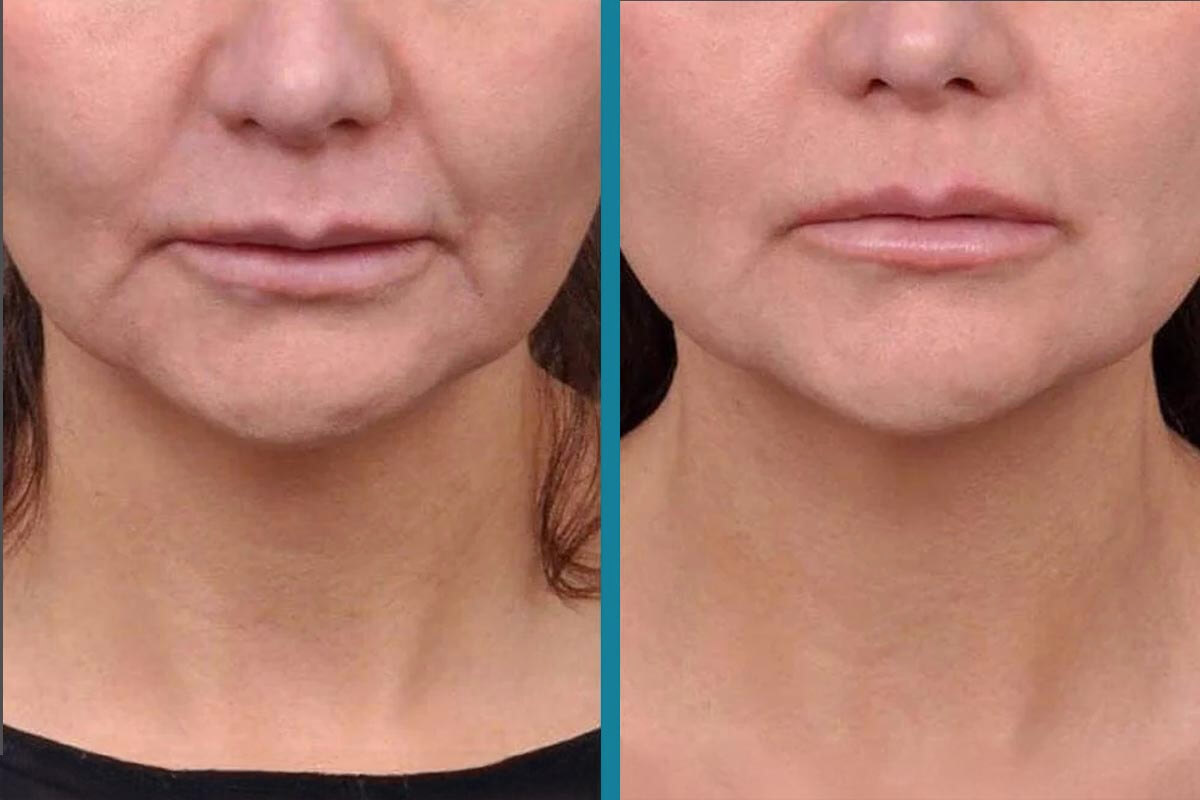 double chin liposuction 12