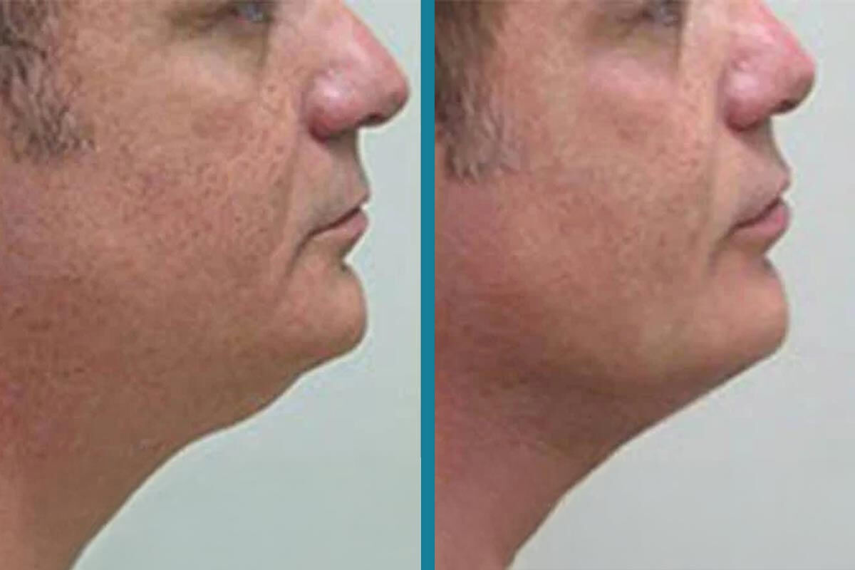 double chin liposuction 13