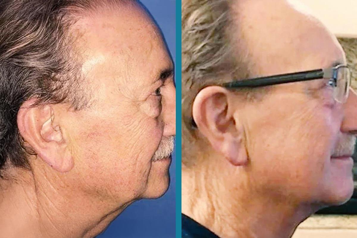 double chin liposuction 14