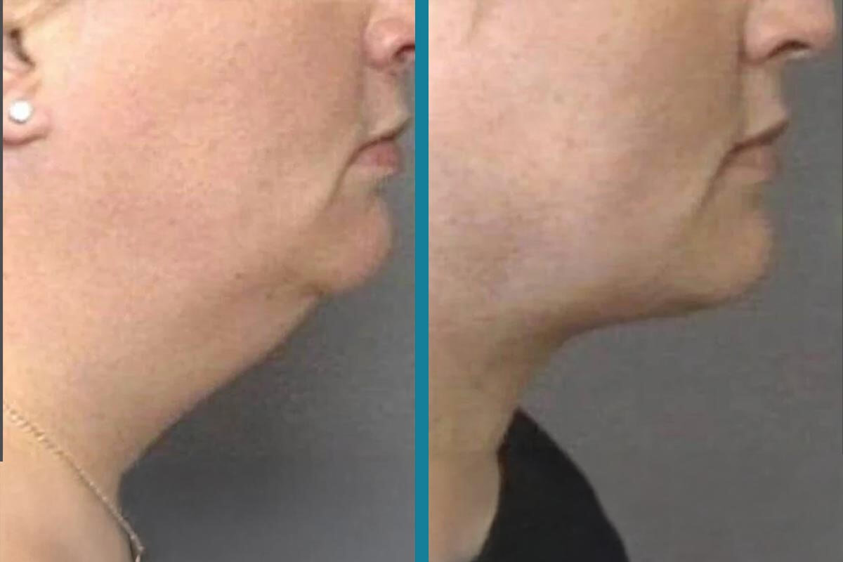 double chin liposuction 15