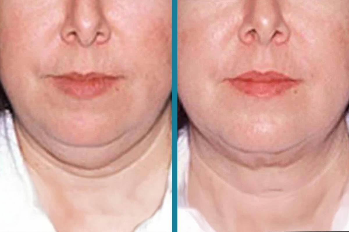 double chin liposuction 17