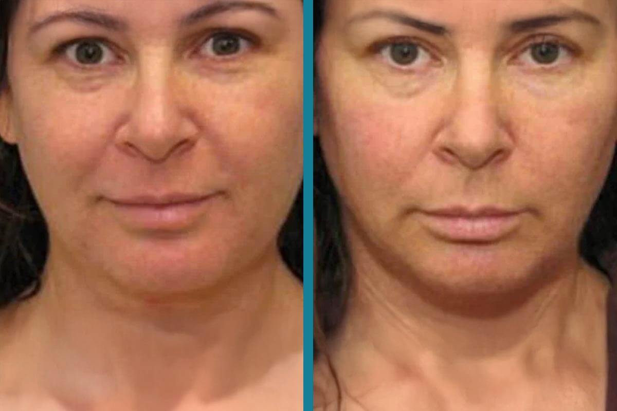 double chin liposuction 18