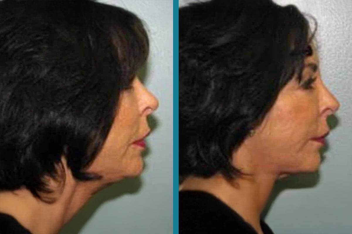 double chin liposuction 19