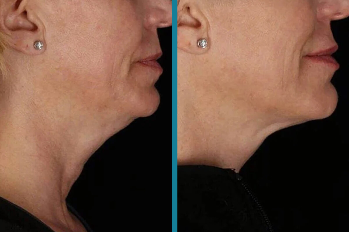 double chin liposuction 2 1