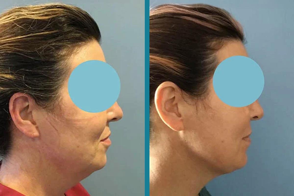double chin liposuction 3