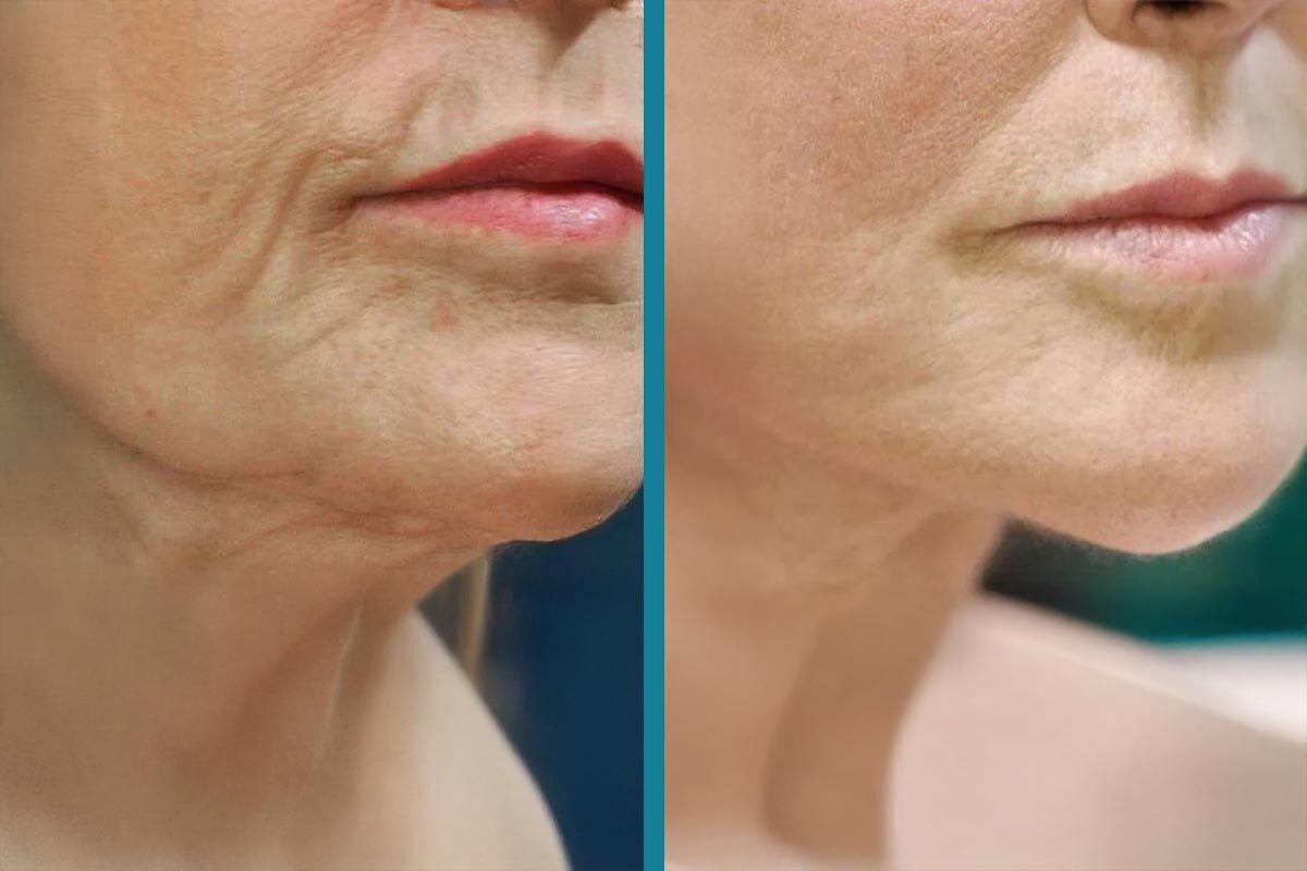 double chin liposuction 4