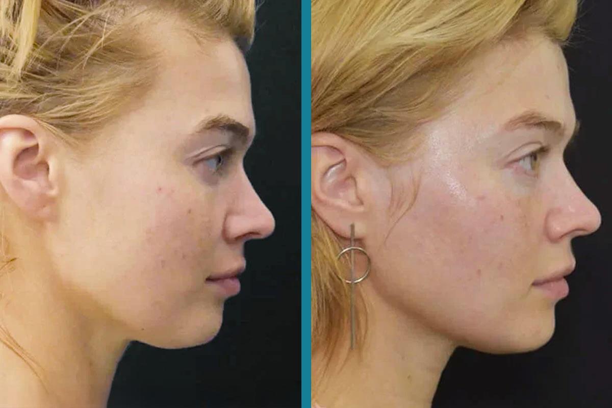 double chin liposuction 6