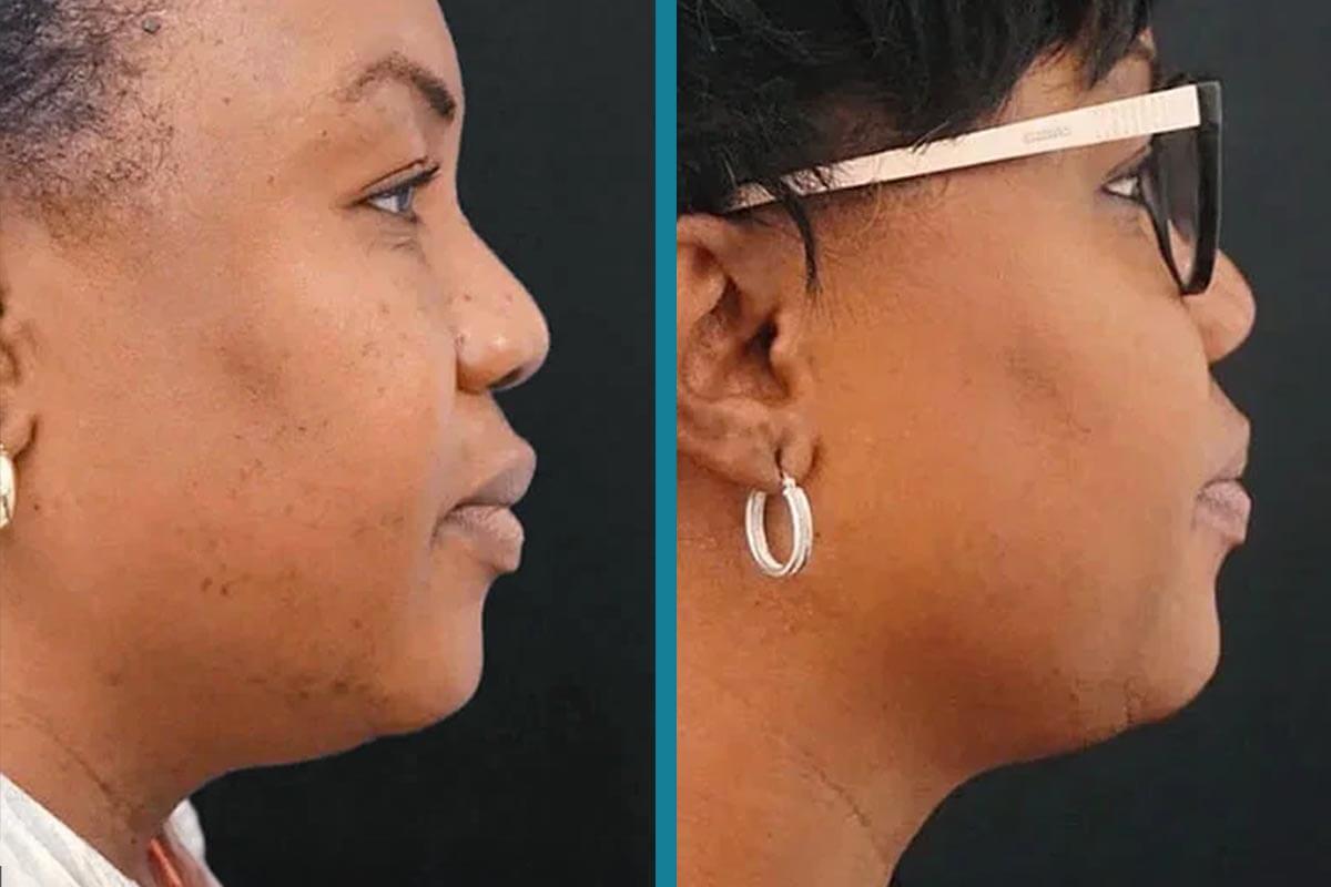 double chin liposuction 7
