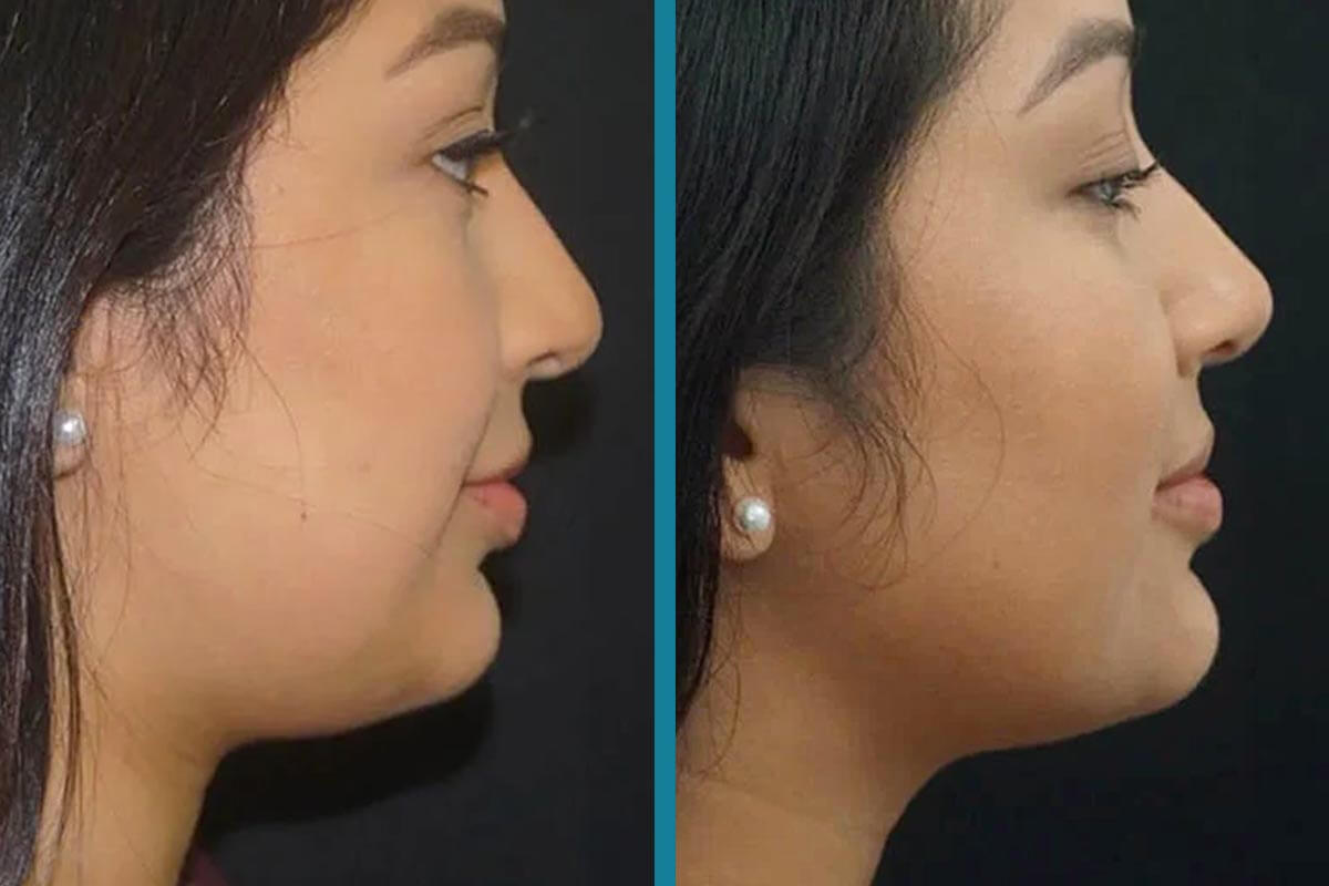 double chin liposuction 8
