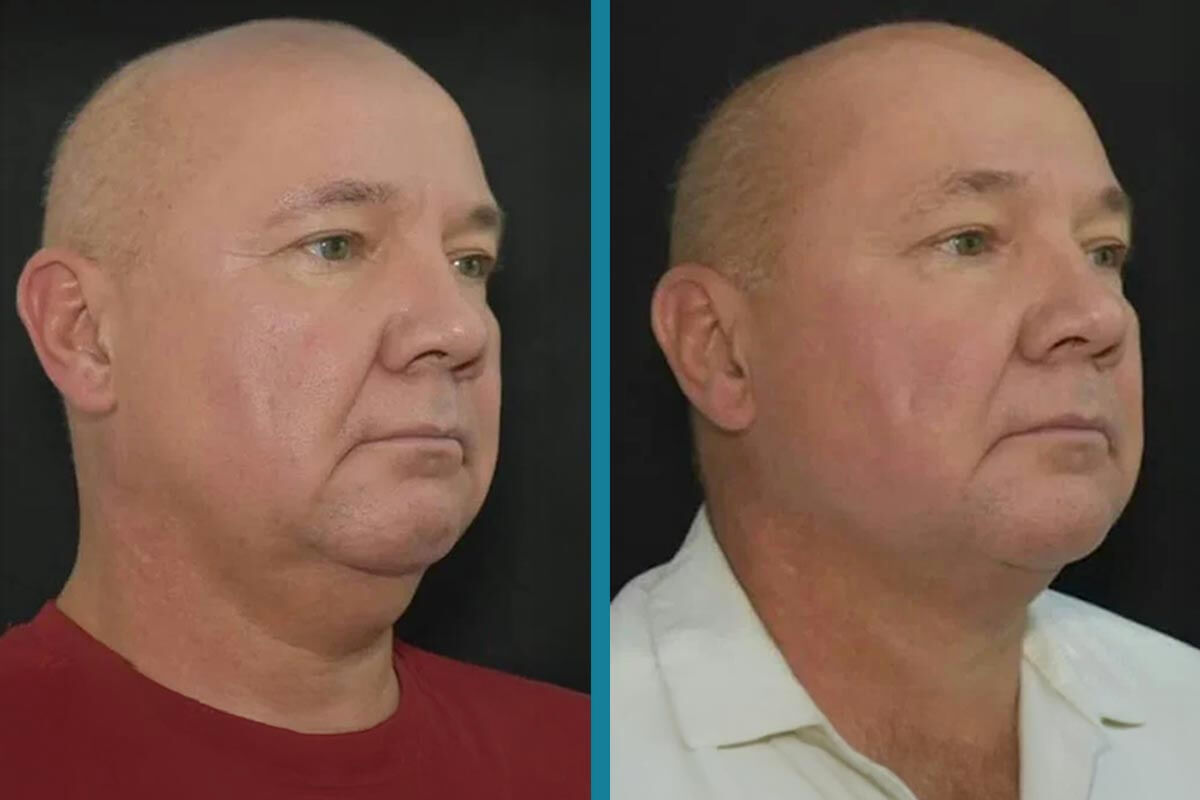 double chin liposuction 9
