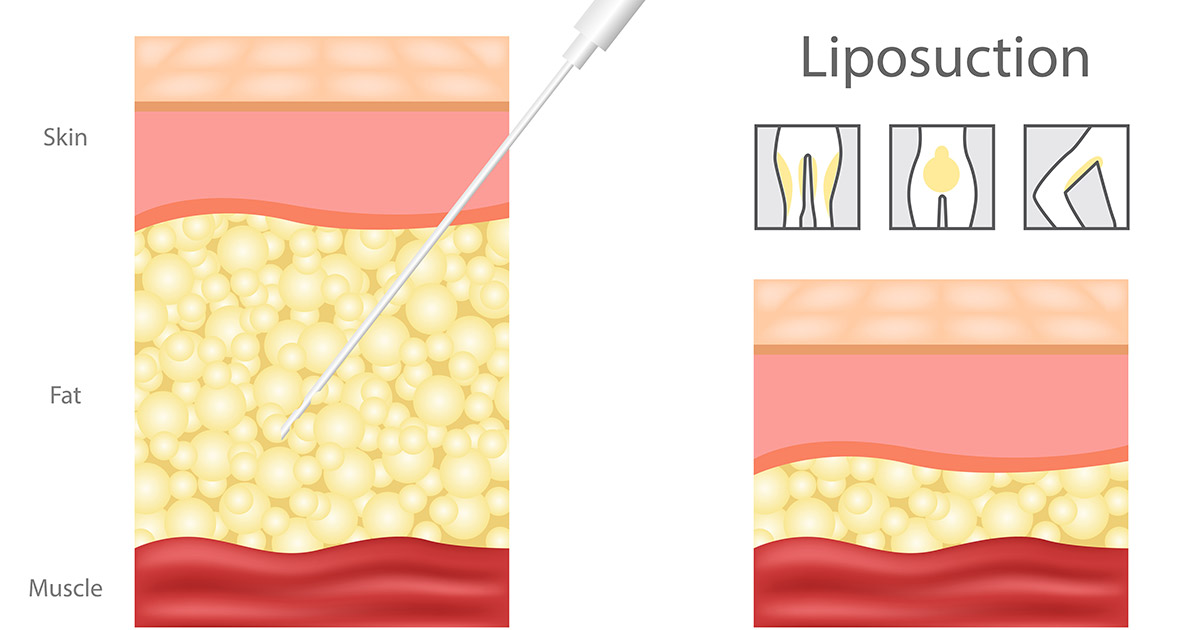 liposuction recovery