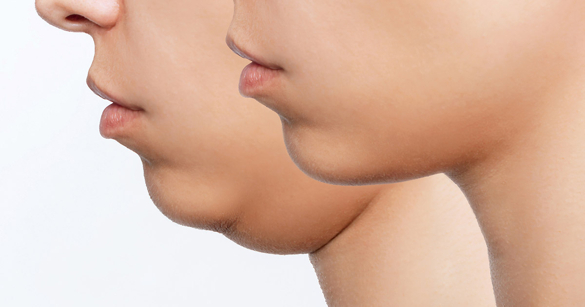 how much does jaw liposuction cost