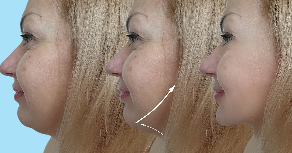 neck and jaw liposuction cost