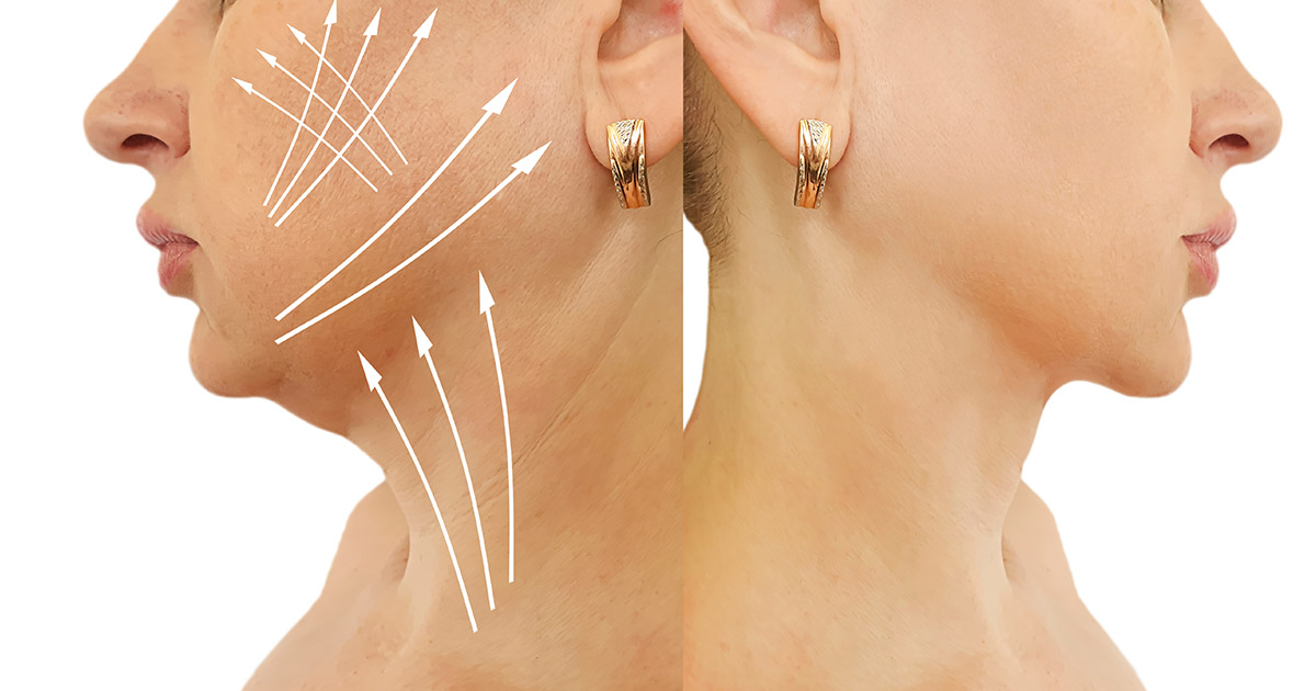 What Affects Chin and Jaw Liposuction Cost