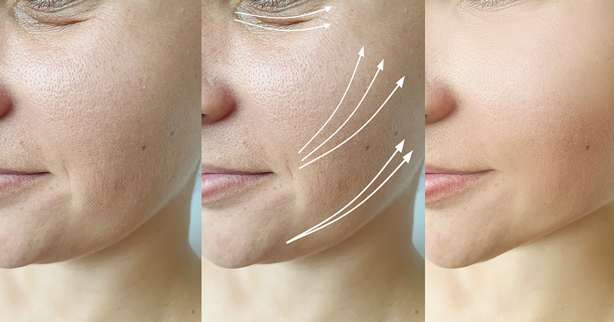 What to Expect Before During & After Jaw Lipo at Alinea