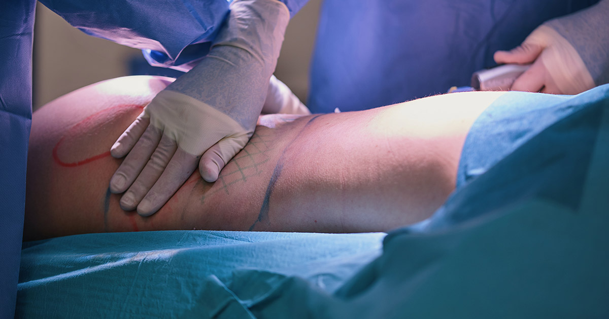 Targeted Fat Removal and Sculpting